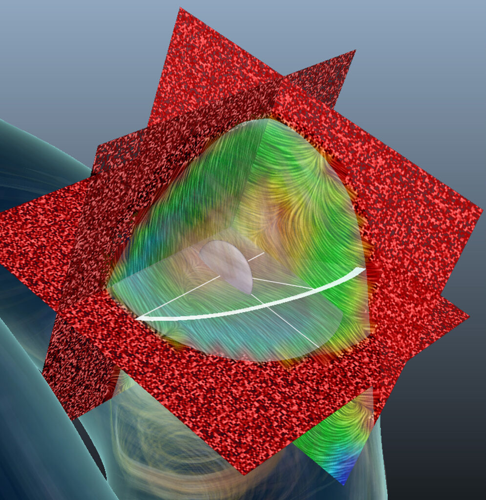 Visualization & Exploration of Blood Flow in Aneurysms – Lehrstuhl für ...