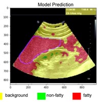 A Machine Learning Approach Towards Fatty LiverDisease Detection In Liver Ultrasound Images