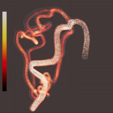 Interactive Visualization of Cerebral Blood Flow for Arteriovenous Malformation Embolisation