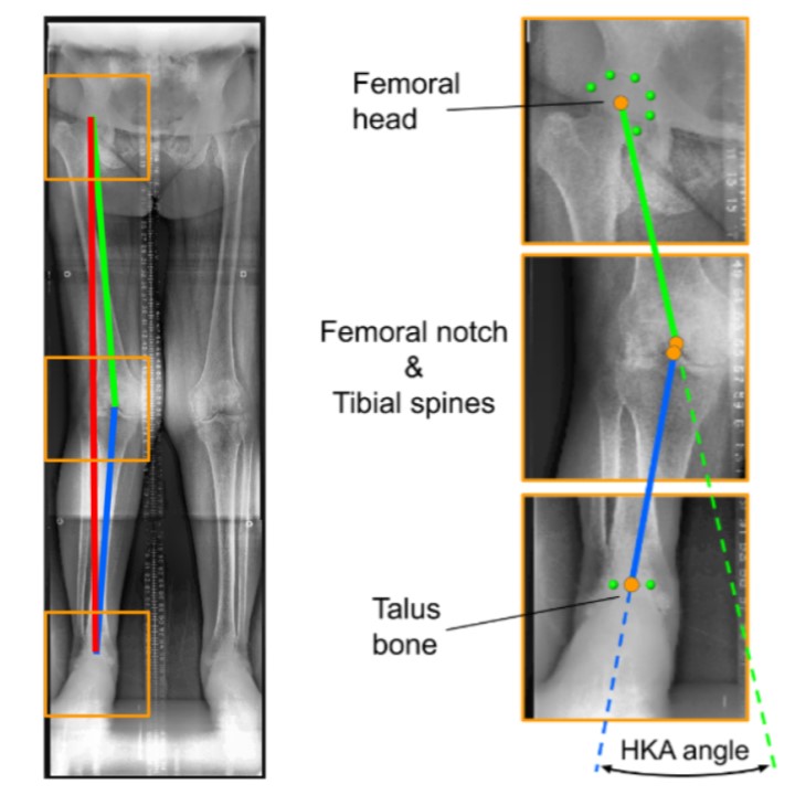 Fully automated Assessment of Knee Alignment from Full-Leg X-Rays employing a "YOLOv4 And Resnet Landmark regression Algorithm" (YARLA): Data from the Osteoarthritis Initiative}