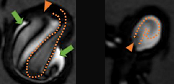 Focal enhancement in intracranial aneurysms - effects of local hemodynamics on VW-MRI signals