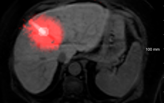 A novel tool for monitoring and assessing the outcome of thermal ablations of hepatic lesions