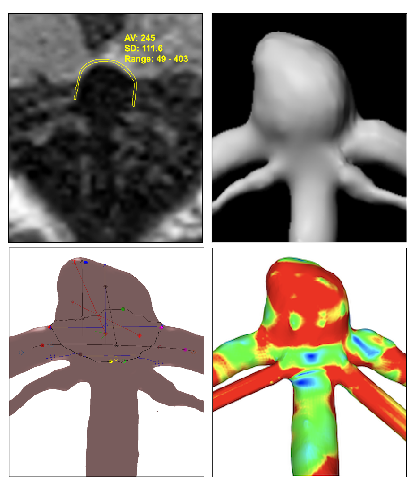 Aneurysm Wall Enhancement Is Associated With Decreased Intrasaccular IL-10 and Morphological Features of Instability