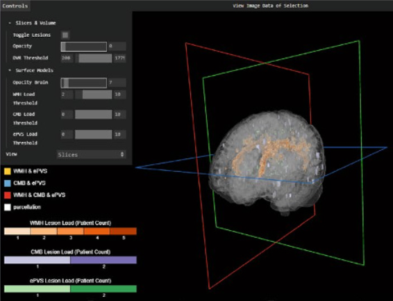 Visual Analysis of Brain Lesion Load in Patients with Cerebral Small Vessel Disease