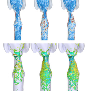 CFD simulations of inhalation through a subject-specific human larynx – Impact of the unilateral vocal fold immobility