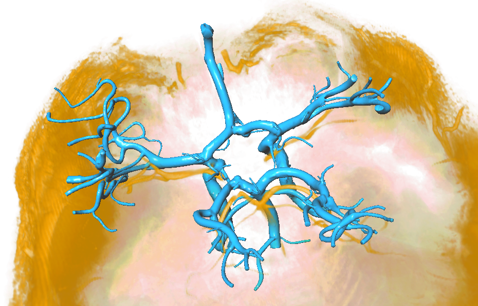 A hybrid hierarchical strategy for registration of 7T TOF-MRI to 7T PC-MRI intracranial vessel data