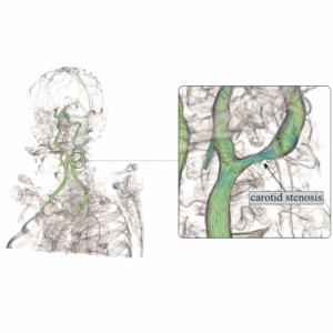 Visualizing Carotid Blood Flow Simulations for Stroke Prevention