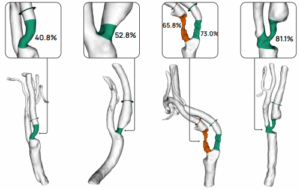 Visualizing Carotid Stenoses for Stroke Treatment and Prevention