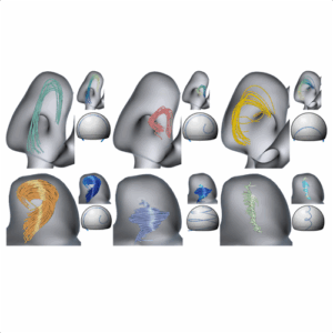 Classification of Blood Flow Patterns in Cerebral Aneurysms