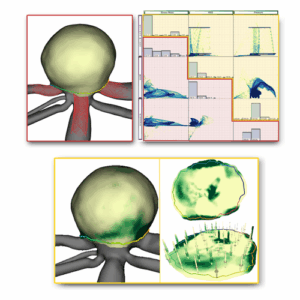 Visual Analysis of Aneurysm Data using Statistical Graphics