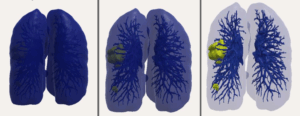 Interaction in Narrative Medical Visualization: Insights from a Case Study on Tumor Diseases