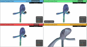 Visualization Support for Remote Collaborative Aneurysm Treatment Planning