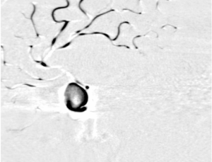 Virtual DSA Visualization of Simulated Blood Flow Data in Cerebral Aneurysms