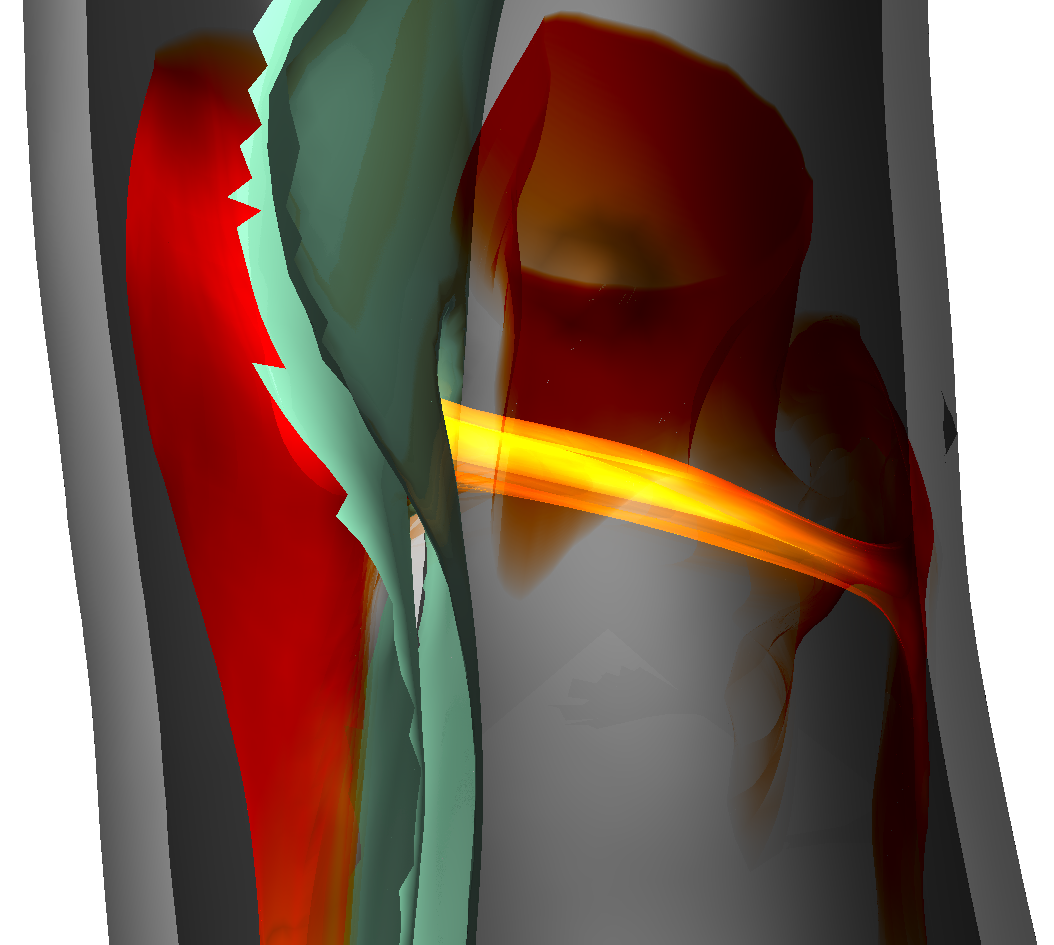 Understanding Aortic Dissection Hemodynamics: Evaluating Adapted Smoke Surfaces Against Streakline-Based Techniques