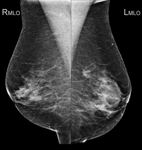 Bestimmung der Kontrastempfindlichkeit im Mammogramm und ihre Bedeutung für die bildbasierte Befundung