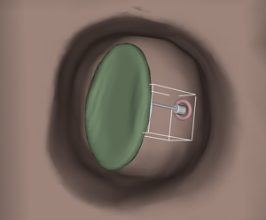 A Comparative User Study of a 2D and an Autostereoscopic 3D Display for a Tympanoplastic Surgery