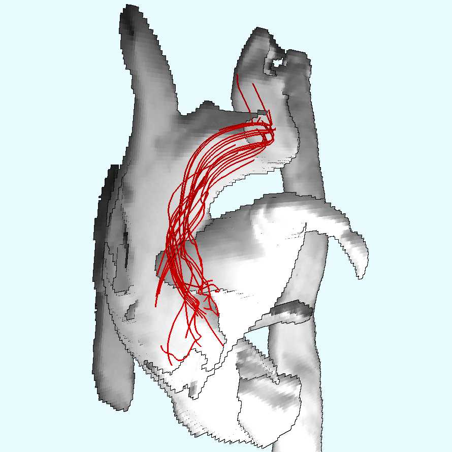 Enhancing Visibility of Blood Flow in Volume Rendered Cardiac 4D PC-MRI Data
