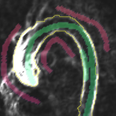 Semi-Automatic Vessel Boundary Detection in Cardiac 4D PC-MRI Data Using FTLE fields