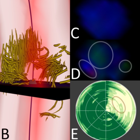 A Framework for Visual Comparison of 4D PC-MRI Aortic Blood Flow Data