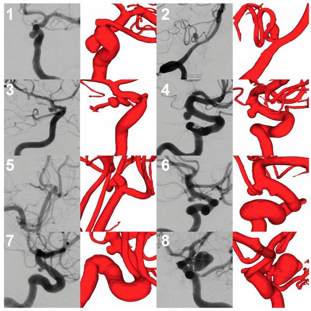 Does the DSA reconstruction kernel affect hemodynamic predictions in intracranial aneurysms? An analysis of geometry and blood flow variations