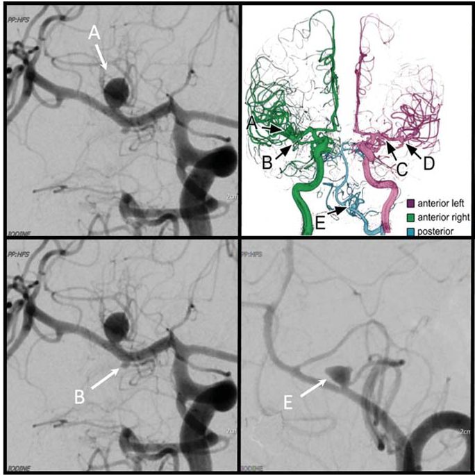 Multiple Aneurysms AnaTomy CHallenge 2018 (MATCH): Phase I: Segmentation