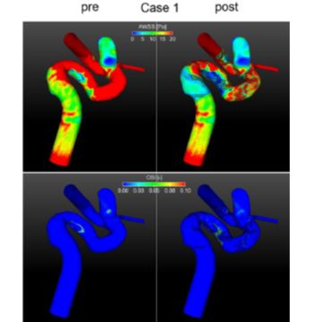 Virtual stenting of intracranial aneurysms: A pilot study for the prediction of treatment success based on hemodynamic simulations