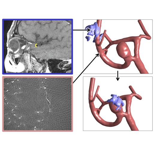 Local flow analysis in unruptured middle cerebral artery aneurysms with vessel wall enhancement