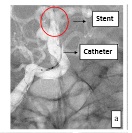 Automatic stent and catheter marker detection in X-ray fluoroscopy using adaptive thresholding and classification