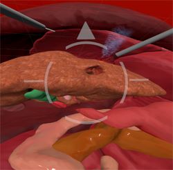 Collaborative Virtual Reality for Laparoscopic Liver Surgery Training