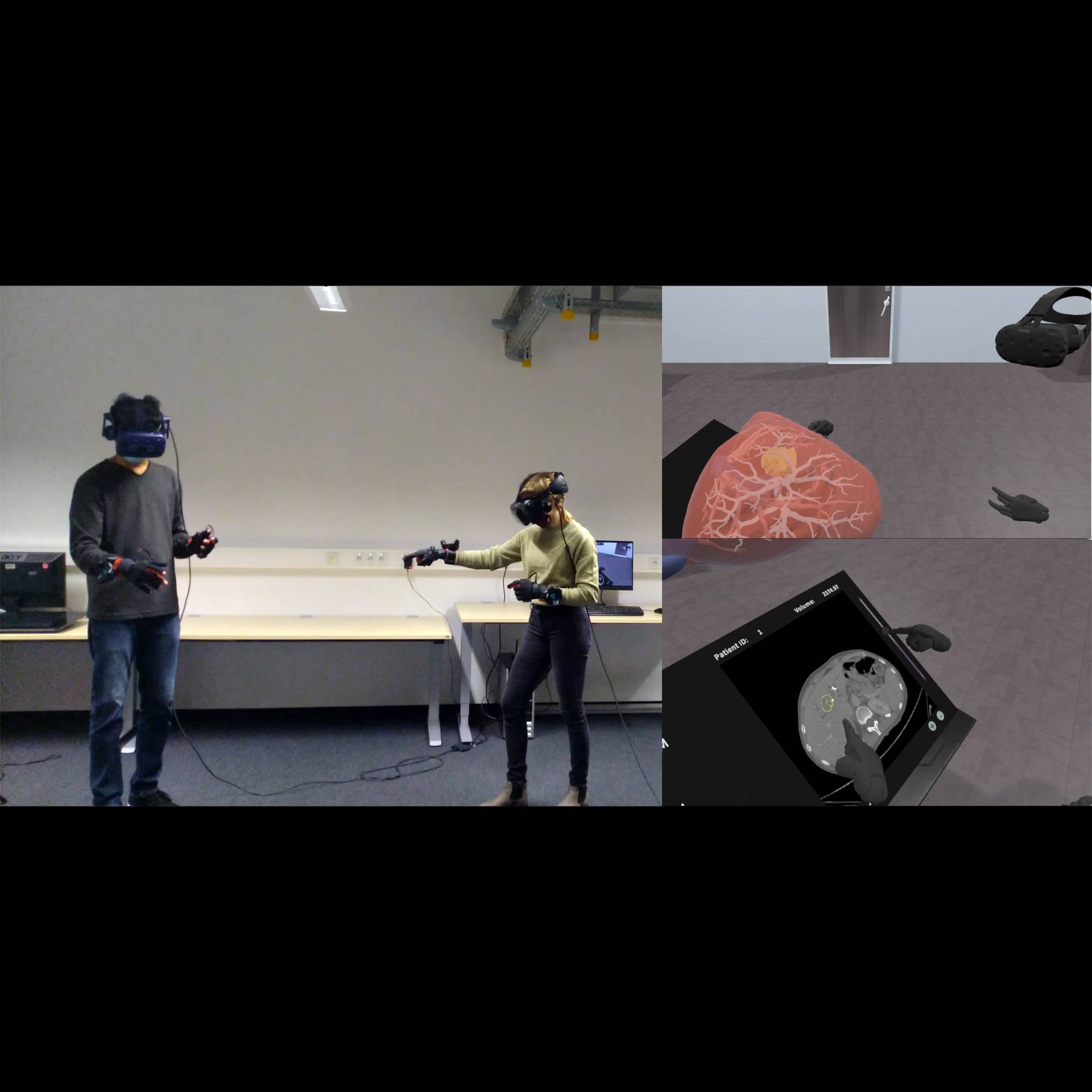 Collaborative VR for Liver Surgery Planning using Wearable Data Gloves: An Interactive Demonstration