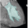 Extracting the Fine Structure of the Left Cardiac Ventricle in 4D CT Data - A Semi-Automatic Segmentation Pipeline