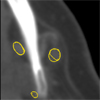 Automatische Detektion von Lymphknoten in CT-Datensätzen des Halses