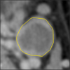 Model-based Segmentation of Pathological Lymph NOdes in CT Data
