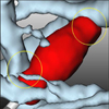 Visualisierung von Simulationsparametern thermischer Tumorablationsverfahren