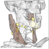 Curvature- and Model-Based Surface Hatching of Anatomical Structures Derived from Clinical Volume Datasets