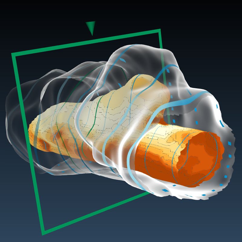 Combined Visualization of Wall Thickness and Wall Shear Stress for the Evaluation of Aneurysms