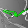 Reconstruction of 3D Surface Meshes for Bood Flow Simulations of Intracranial Aneurysms