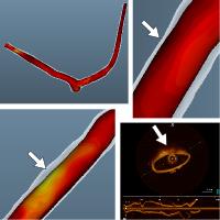 Extraction of Patient-Specific 3D Cerebral Artery and Wall Thickness Models from 2D OCT and Structured-Light 3D Scanner Data