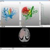 Impact of Model-based Risk Analyses for Liver Surgery Planning