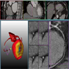 CT Late Enhancement Segmentation for the Combined Analysis of Coronary Arteries and Myocardial Viability