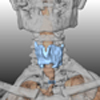 3-D Visualisation of CT-data for Surgical Planning in Trachea Resection: Proof of Concept
