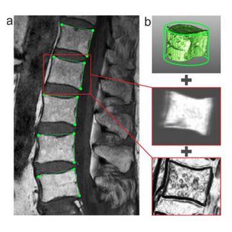 Hybrid Level-Sets for Vertebral Body Segmentation in Clinical Spine MRI