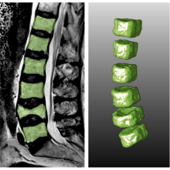 Vertebral body segmentation in wide range clinical routine spine MRI data