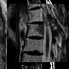 Regionenbasierte rigide Bildregistrierung von präoperativen MR- und intraoperativen Dyna-CT-.Bildern zur Interventionsunterstützung bei Wirbelkörpermetastasen