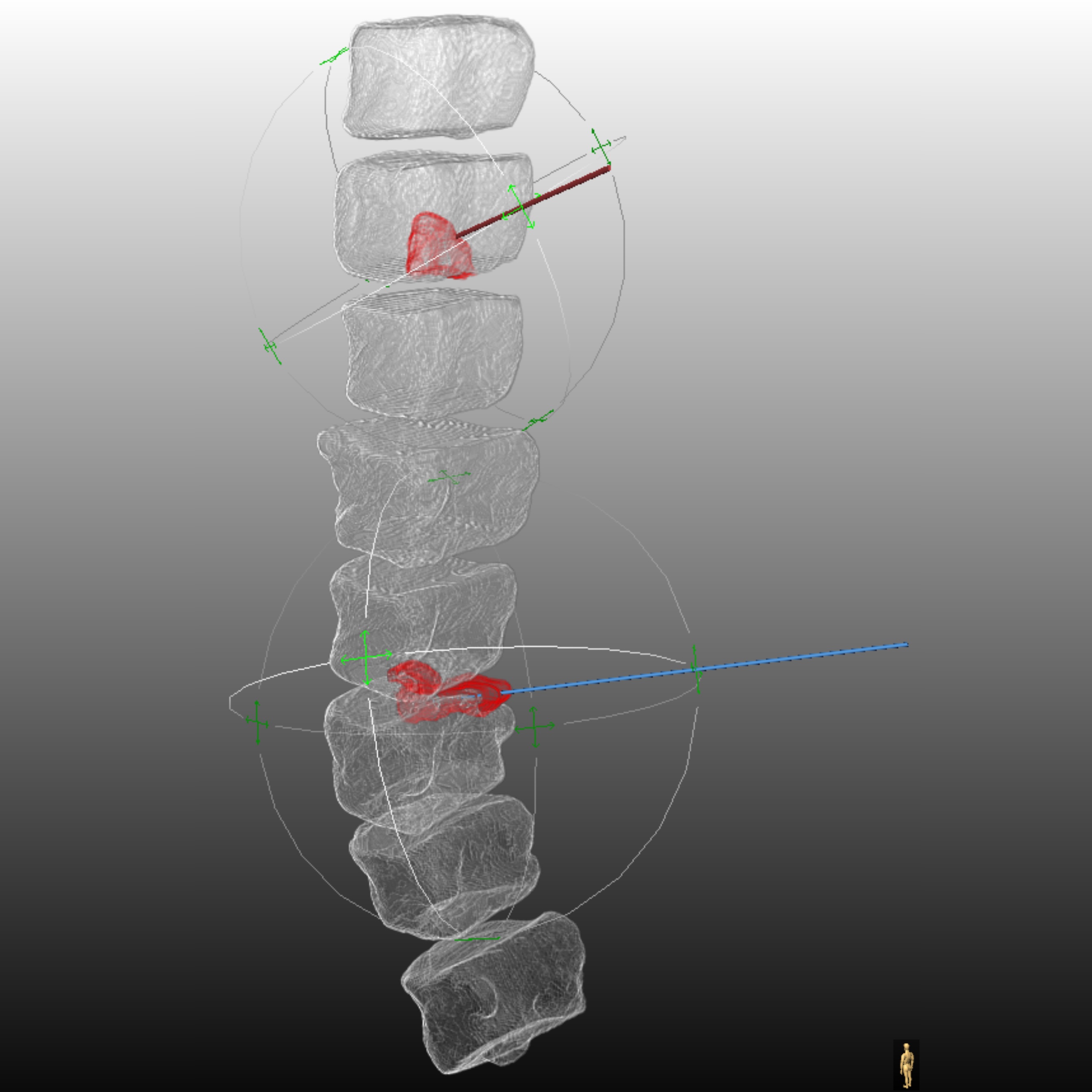 Assessing the Benefits of Interactive Patient-Specific Visualisations for Patient Information