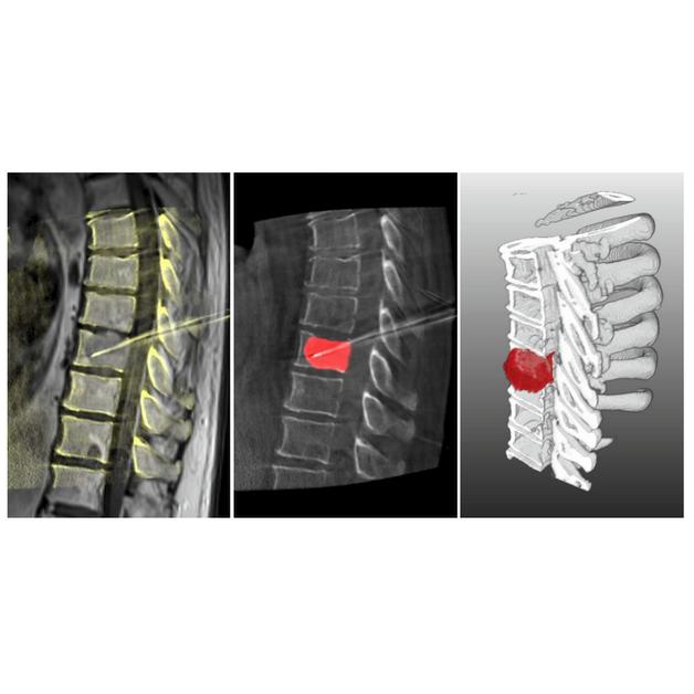 Multi-segmental spine image registration supporting image-guided interventions of spinal metastases