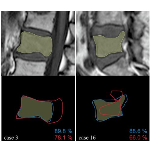 Segmentation of Vertebral Metastases in MRI Using an U-Net like Convolutional Neural Network