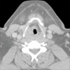 Bildanalyse für die präoperative Planung von Neck Dissections