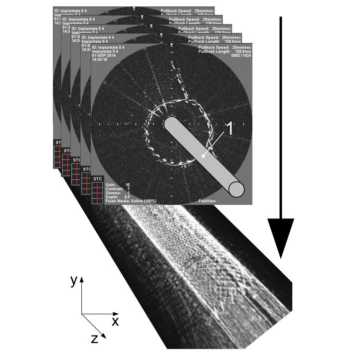 Intravascular Optical Coherence Tomography (OCT) as an Additional Tool for the Assessment of Stent Structures