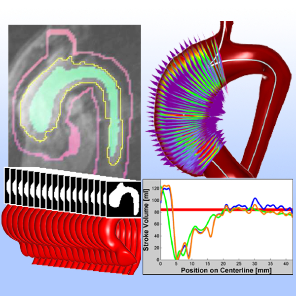Motion-aware stroke volume quantification in 4D PC-MRI data of the human aorta